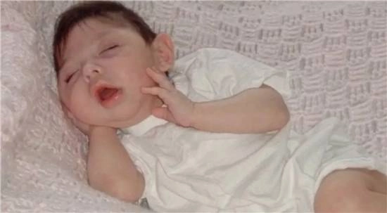 天生无脑的美国女子迎来20岁生日，创下最长存活纪录