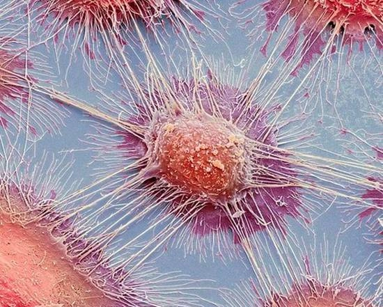 衰老或许能抑制癌症进展：人类癌症发病率在85岁之后有所下降