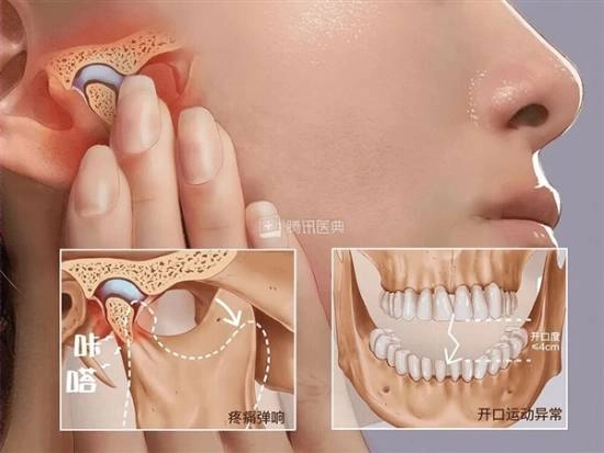 00后女生晨起突发张口困难，经诊断患上“TMD”