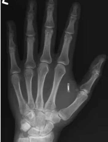 太有赛博朋克那味儿了！魔术师手上植入芯片后，居然把密码给忘了