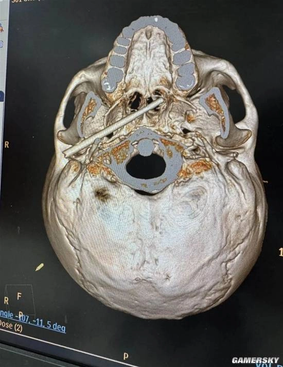 筷子插入颅底的患者被医生成功救治，距大动脉仅5毫米！