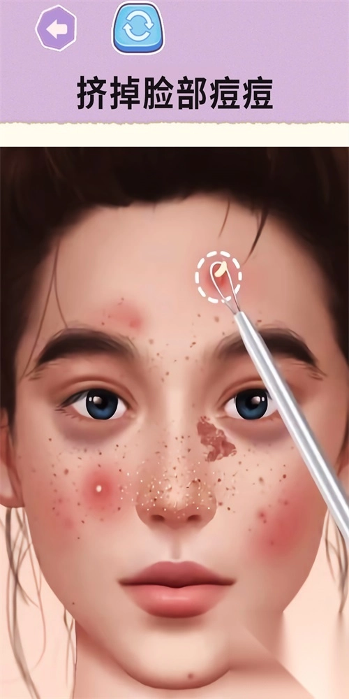 挤痘大师2025
